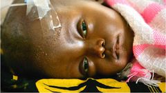 Cerebral Malaria: Seek help timely to avoid Neurocognitive Sequelae