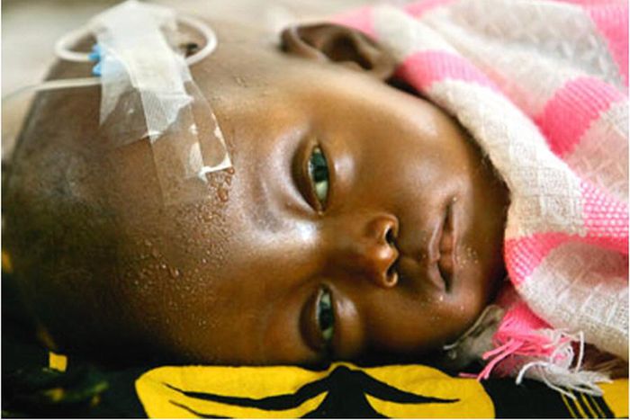 Cerebral Malaria: Seek help timely to avoid Neurocognitive Sequelae