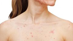Chest acne