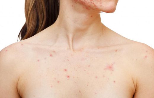 Chest acne