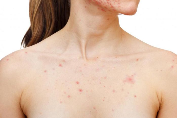 Chest acne