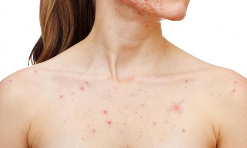 Chest acne