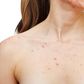 Chest acne
