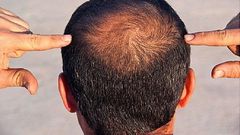Hair loss