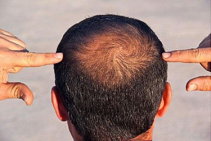 Hair loss