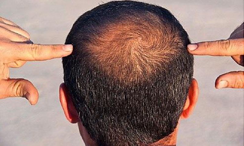 Hair loss