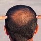 Hair loss