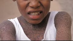 11-year old boy always isolates himself to cry as bullies call him crocodile (video)