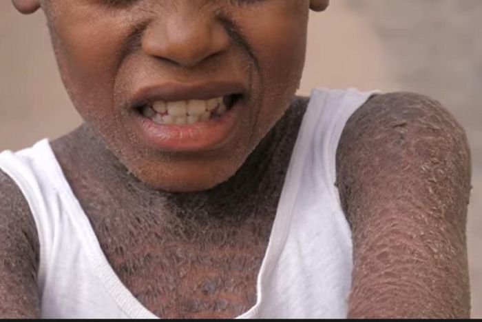 11-year old boy always isolates himself to cry as bullies call him crocodile (video)