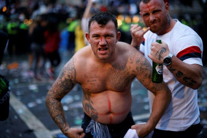 An England fan, injured by a flying bottle, poses for a photograph on the edge of Trafalgar Square during a live screening of the UEFA EURO 2020 final