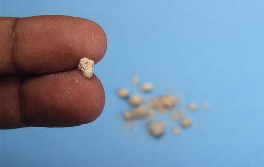 What are kidney stones?