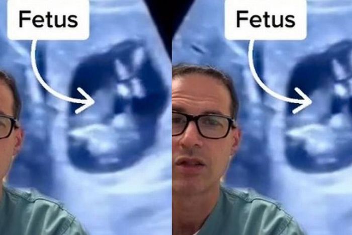 Doctors find baby inside woman’s liver instead of the womb