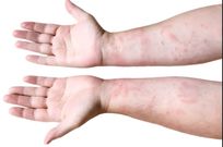 Here are 5 sexually transmitted diseases you should watch out for in 2025