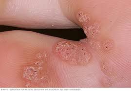Here are 5 sexually transmitted diseases you should watch out for in 2025