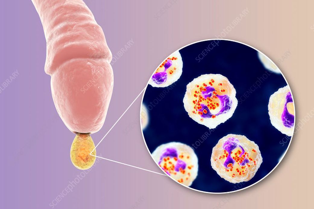 Here are 5 sexually transmitted diseases you should watch out for in 2025