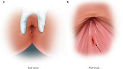 5 health complications you can develop from having anal sex