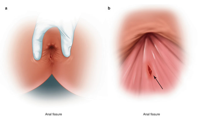 5 health complications you can develop from having anal sex
