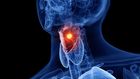 Doctors report a troubling increase in throat cancer cases among younger patients, attributing this trend to the prevalence of oral sex.