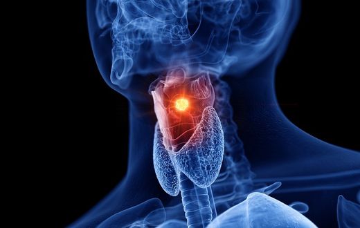 Doctors report a troubling increase in throat cancer cases among younger patients, attributing this trend to the prevalence of oral sex.