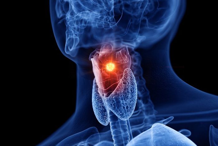 Doctors report a troubling increase in throat cancer cases among younger patients, attributing this trend to the prevalence of oral sex.