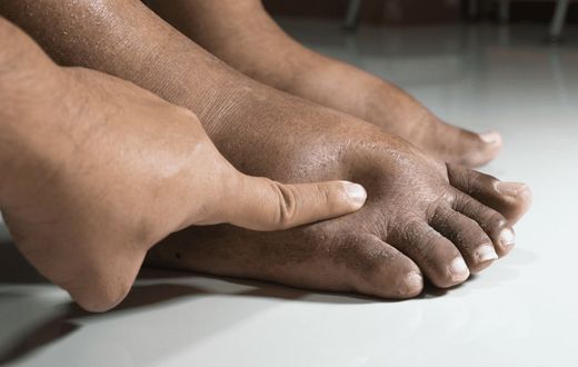 What causes feet swelling in pregnant women? [careplusfoot]