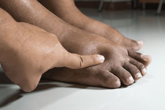 What causes feet swelling in pregnant women? [careplusfoot]