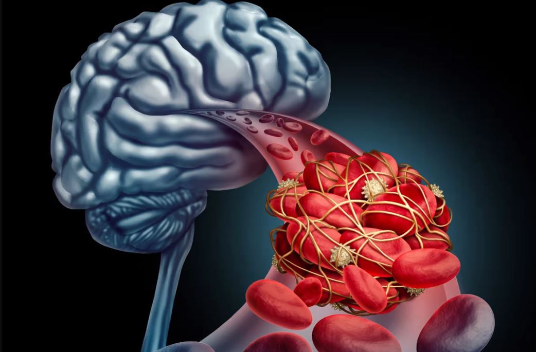 5 reasons you get a headache after an intense orgasm and how to prevent it