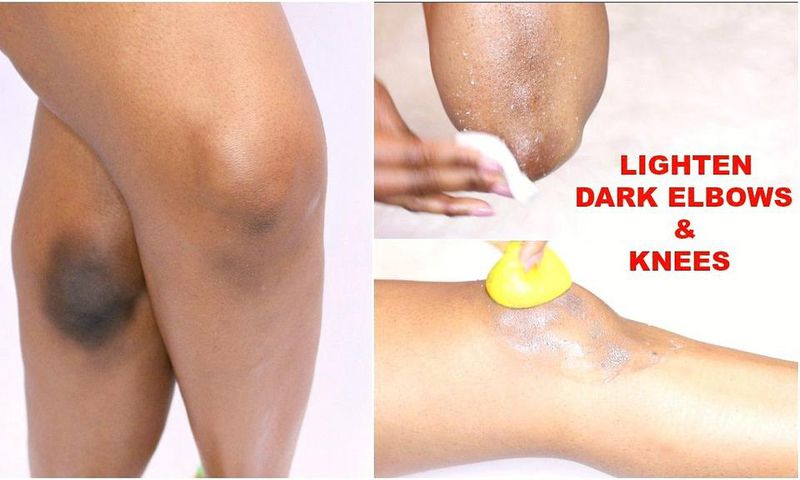 Here are 5 ways to naturally get rid of dark elbows and knees