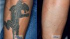 5 natural tattoo removal remedies you can try at home