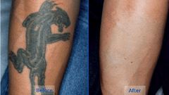 5 natural tattoo removal remedies you can try at home
