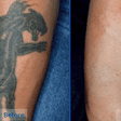 5 natural tattoo removal remedies you can try at home