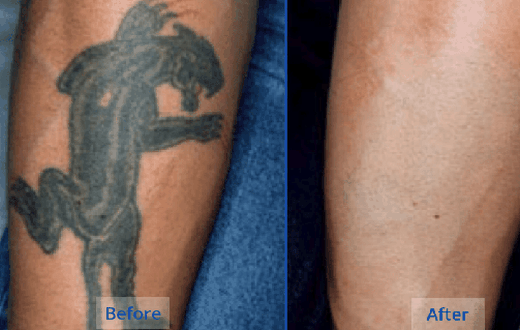 5 natural tattoo removal remedies you can try at home