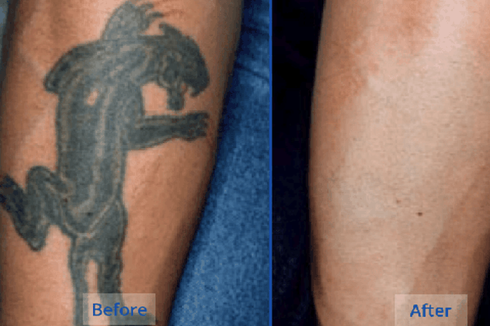 5 natural tattoo removal remedies you can try at home