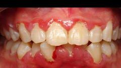 3 home remedies to get rid of gingivitis. [pinterest]