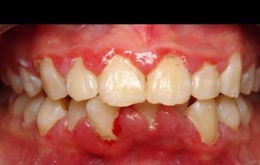 3 home remedies to get rid of gingivitis. [pinterest]