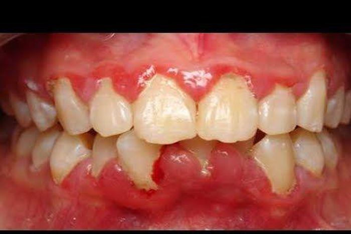 3 home remedies to get rid of gingivitis. [pinterest]