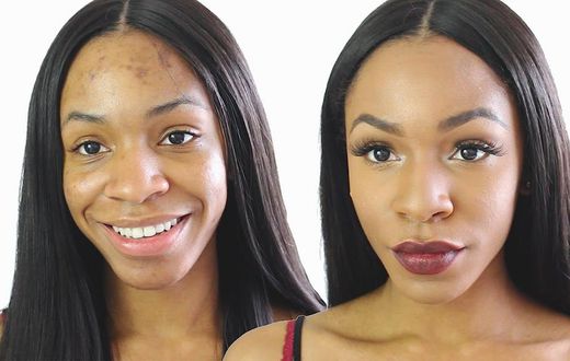 Ance Scars and other blemishes can be perfectly concealed with makeup but they are better treated