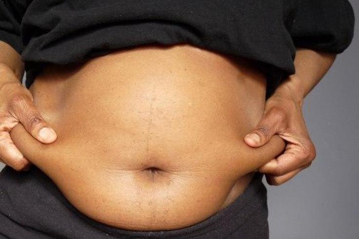 Liposuction (removal of fat from the abdomen and other parts of the body) has major health risks [ece-auto-gen]