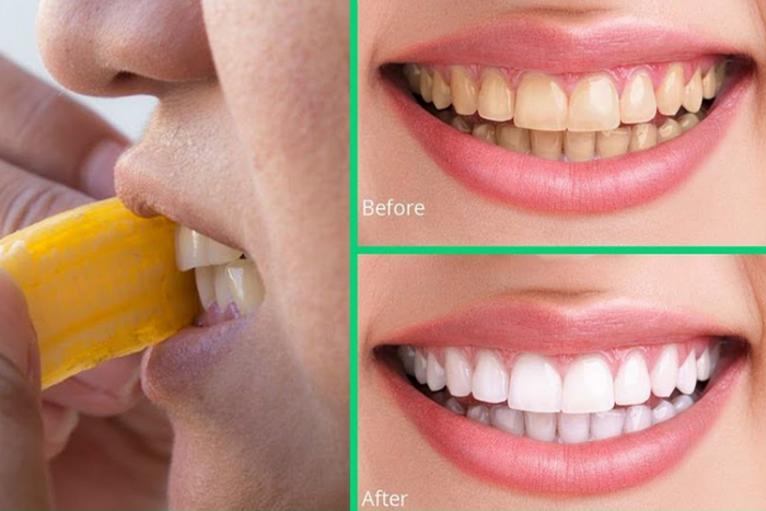 How to whiten the teeth using banana peels