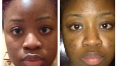 5 natural ways to remove black spots at home