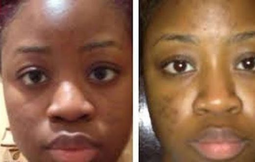 5 natural ways to remove black spots at home