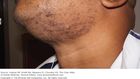 5 fast ways to treat razor bumps at home