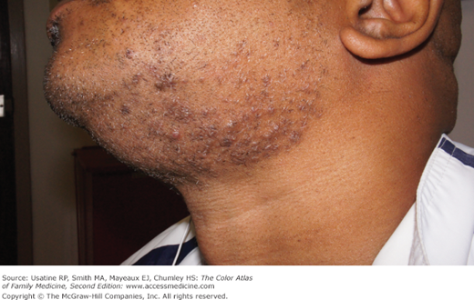 5 fast ways to treat razor bumps at home
