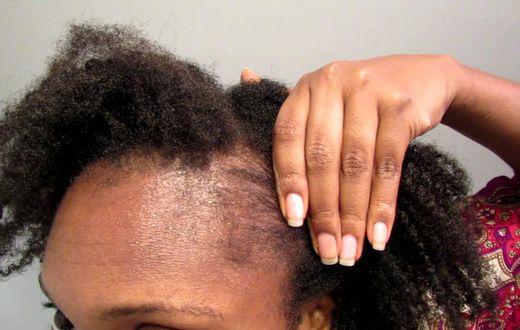 ___8227781___2018___4___9___16___Edges+Regrow+your+hair+guide