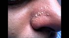4 natural ways to get rid of whiteheads on the nose