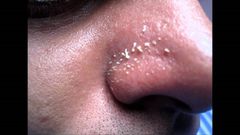 4 natural ways to get rid of whiteheads on the nose