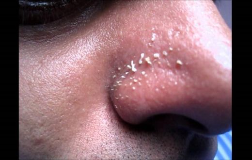 4 natural ways to get rid of whiteheads on the nose