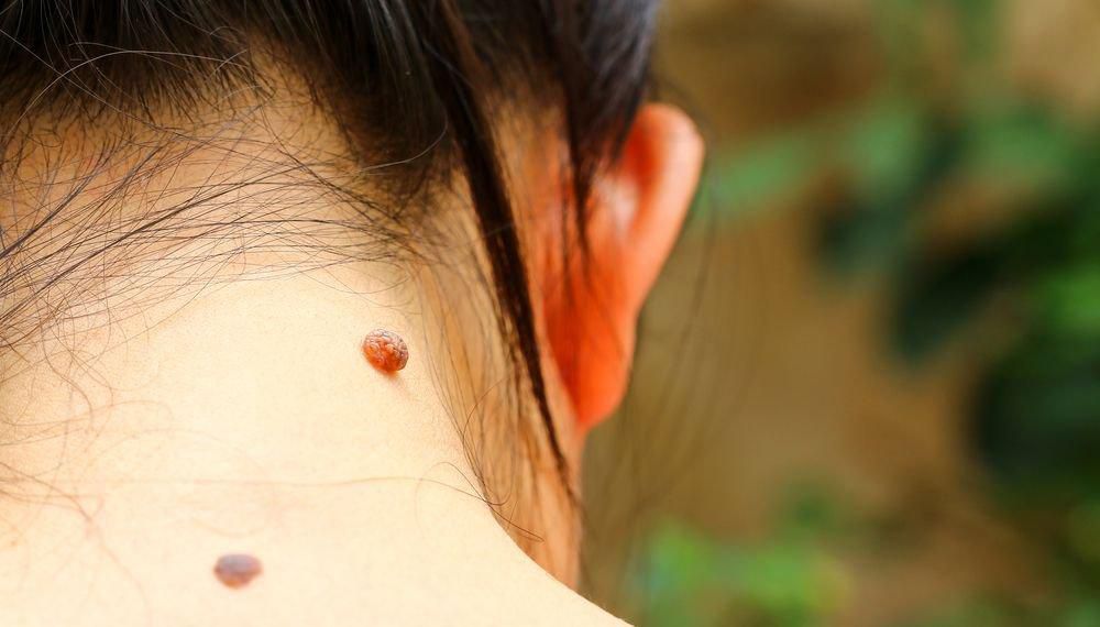 Birthmark on the back of neck [DrPassaretti]