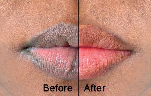 5 kitchen ingredients that you can use for pink lips [Medium]