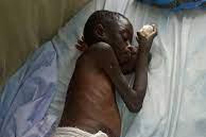 Stock photo: Burnt child